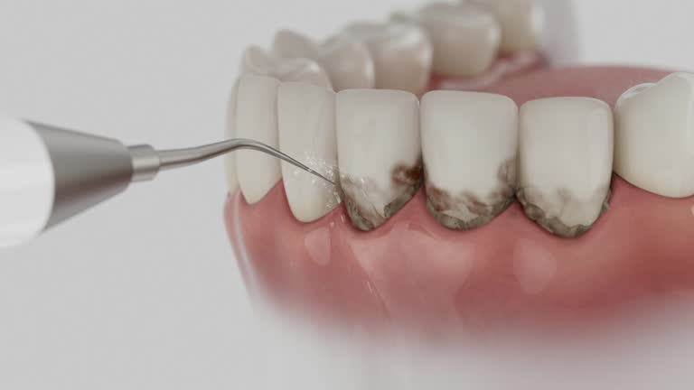 Trusted Dental Crowns And Bridges service in Blue Ridge, VA - Dentist Open Now
